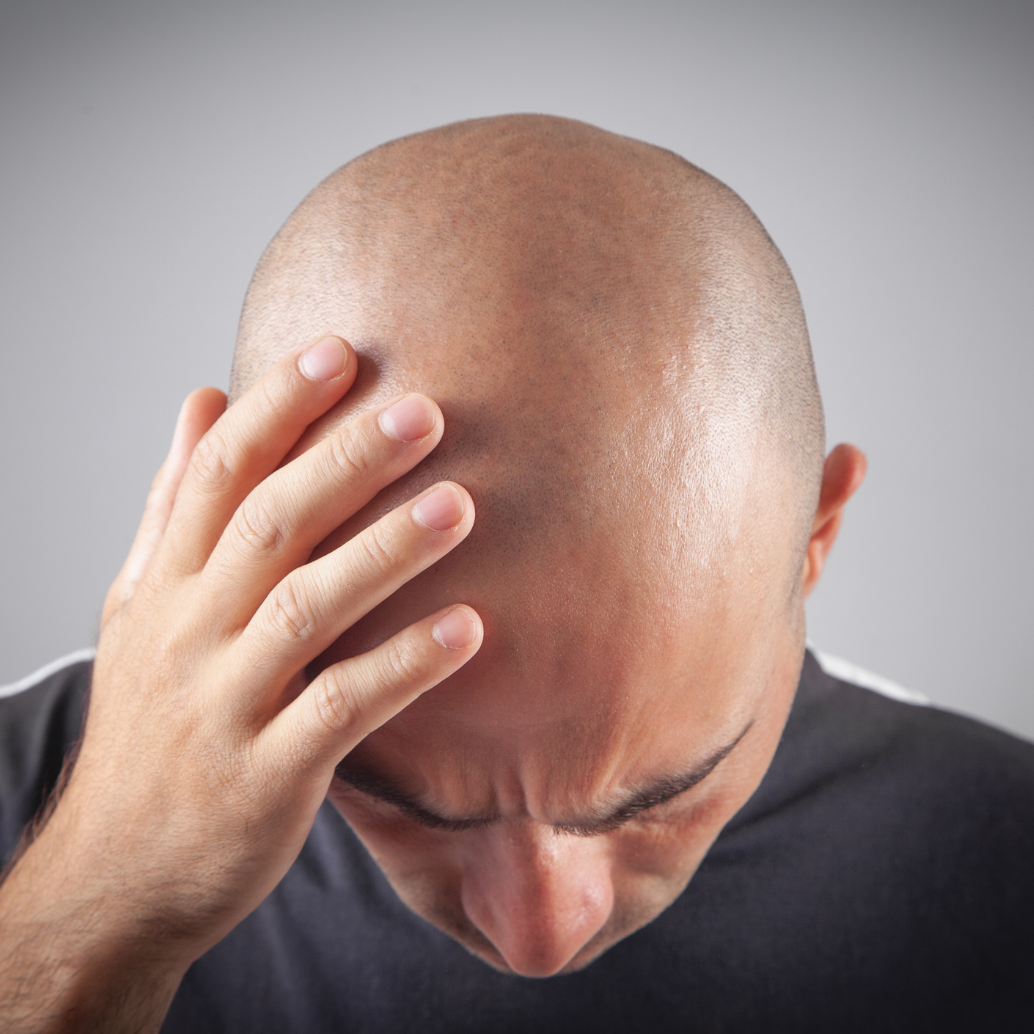 e quando os carecas começam a causar problemas